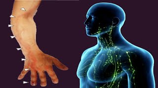 Lymphangitis Causes And Symptoms [upl. by Kancler]