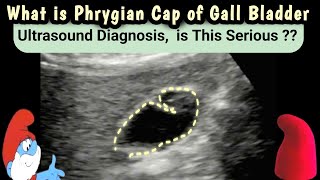 What is Phrygian Cap of Gall bladder  Ultrasound  Diagnosis  is this serious [upl. by Arim]