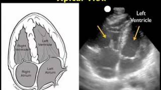 How to Cardiac Ultrasound  Apical View Case Study [upl. by Nohsal]