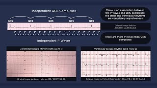 3rd Degree AV Block ECG  EMTprepcom [upl. by Indnahc]