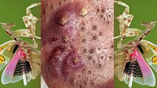 Relax squeezing out blackheads 41 Черные точки [upl. by Boorman]