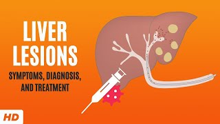 Liver Lesions Symptoms Diagnosis and Treatment [upl. by Damas]