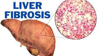 Liver Fibrosis  What are the symptoms of liver fibrosis  247nht [upl. by Nomed]