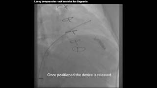 Leadless Pacemaker Insertion [upl. by Davidson285]