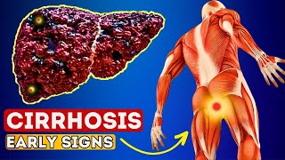 12 Early Signs of Liver CIRRHOSIS  LIVER is DYING [upl. by Raclima]