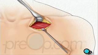 Permanent Pacemaker Implant Surgery • PreOp® Patient Education ❤ [upl. by Uohk]