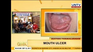 Mouth Ulcer  Canker Sores  Usapang Pangkalusugan [upl. by Nebuer469]