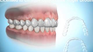 Invisalign Roger Drouin orthodontiste certifié [upl. by Eardnoed688]