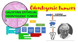 Calcifying epithelial odontogenic tumor CEOTDETAILEDPindborg tumor Tumors of odontogenic origin [upl. by Bud723]