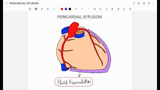 PERICARDIAL EFFUSION [upl. by Eimerej]