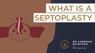 What is a Septoplasty [upl. by Intisar]