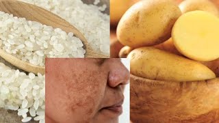 Mascarilla Natural Para Tratar La Pigmentación Facial y Las Manchas 🥔🥔 [upl. by Icram25]