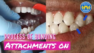 How Invisalign Attachments are placed [upl. by Gustafsson448]