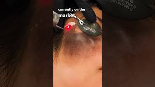 THIS Laser Can Erase Birthmarks Birthmark TreatmentHyperpigmentation laserskincare [upl. by Tirzah976]