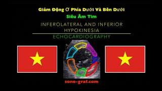 Siêu Âm Tim  Giảm Động Ơ Phía Dưới Và Bên Dưới [upl. by Kcirted]