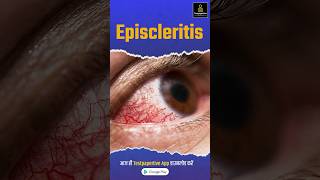 What is Episcleritis  Ophthalmology  eye ophthalmology episcleritis eye peramedical [upl. by Auqinom]