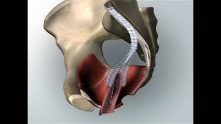 Sacrocolpopexy Animated video about pelvic prolaps surgery [upl. by Gatian]