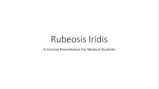 Rubeosis Iridis  Neovascularisation of Iris NVI  For Medical Students [upl. by Gun]