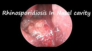 Rhinosporidiosis on Nasal Endoscopy [upl. by Aner]