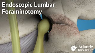 Endoscopic Lumbar Foraminotomy [upl. by Negam917]