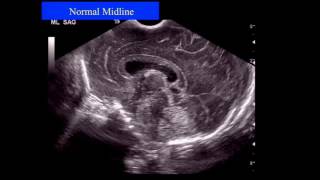 Neonatal Neurosonography The Premature Infant [upl. by Hume]