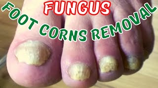 Fungal feet satisfying treatment [upl. by Briana]