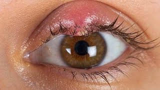 5 Most common eye disease in daily opds eyecareoptom5506 eye eye problems [upl. by Jobyna]