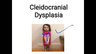 cleidocranial dysplasia [upl. by Atiram826]