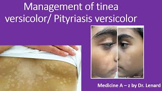 Management of tinea versicolor Pityriasis versicolor [upl. by Thornburg]