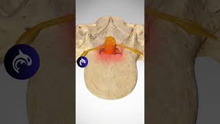 See how Lumbar Stenosis affects the Spine  3D Animation lumbarspinalstenosis backpain backpain [upl. by Adehsor636]