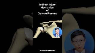 Clavicle Fracture Understanding the Indirect Mechanism and FOOSH Injury [upl. by Nnyleve]