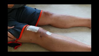 My ACL Surgery Recovery Quadriceps Tendon Graft  Part 3 2 Weeks [upl. by Freiman]