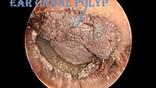 Dried Hemorrhagic Ear Canal Polyp Removal amp Cleaning [upl. by Alyehs]