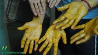 Topical Application of Turmeric Curcumin for Cancer [upl. by Atonsah]