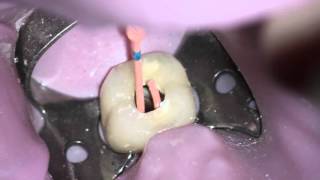 Obturating a TRUShape® case with Dr Gutmann [upl. by Eriam]