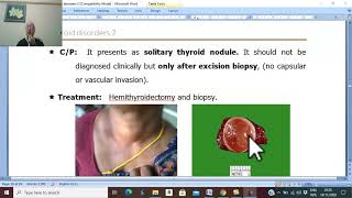 Thyroid disorders in Arabic 18  Thyroid neoplasms  pathology 1   by Dr Wahdan [upl. by Adina]