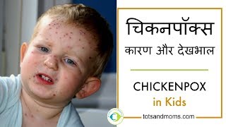 शिशुओं amp बच्चों में चिकनपॉक्स  कारण और देखभाल  Chickenpox in Babies amp Kids in Hindi [upl. by Seuguh]