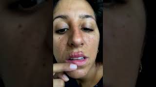 Cystic acne and blackheads removal  Newest pimple pops for 2022 [upl. by Idissac]