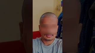 HSN Hair Transplant  Amazing hair transformation  FUE Hair Transplant result  hsn hairclinic [upl. by Anirtal]