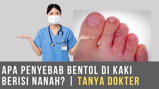 Apa Penyebab Bentol Di Kaki Berisi Nanah  Tanya Dokter [upl. by Rehpotsihc384]