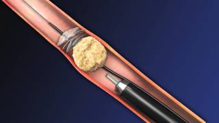 CoAx 10mm Stone Control Catheter from Accordion Medical [upl. by Helve]