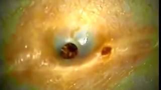 Dilated Pore Of Winer [upl. by Lerim]