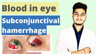 Subconjunctival Hemorrhage Treatment Causes Symptoms  आखों में लाली आना । Redness eye trearment [upl. by Konikow]