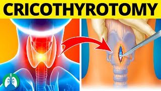 Cricothyrotomy Medical Definition  Quick Explainer Video [upl. by Bal82]