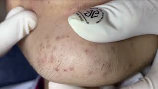 Acne On Girls Chin  Acne Treatment Nhat Bang [upl. by Wayolle]