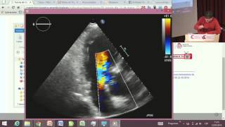 Máster Técnico en Ecocardiografía Tutoría 3 [upl. by Boonie]