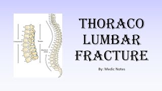 Thoracolumbar fracture  AO classification clinical feature investigation treatment [upl. by Pryce]