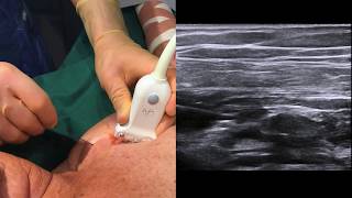 Ultrasoundguided infraclavicular brachial plexus block [upl. by Enasus]