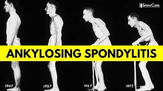 What is Ankylosing Spondylitis Causes Symptoms and Diagnosis EXPLAINED [upl. by Scrivens]