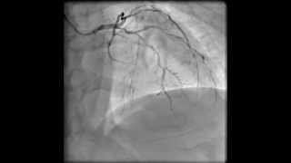 Left coronary angiogram RAO cranial [upl. by Teleya]